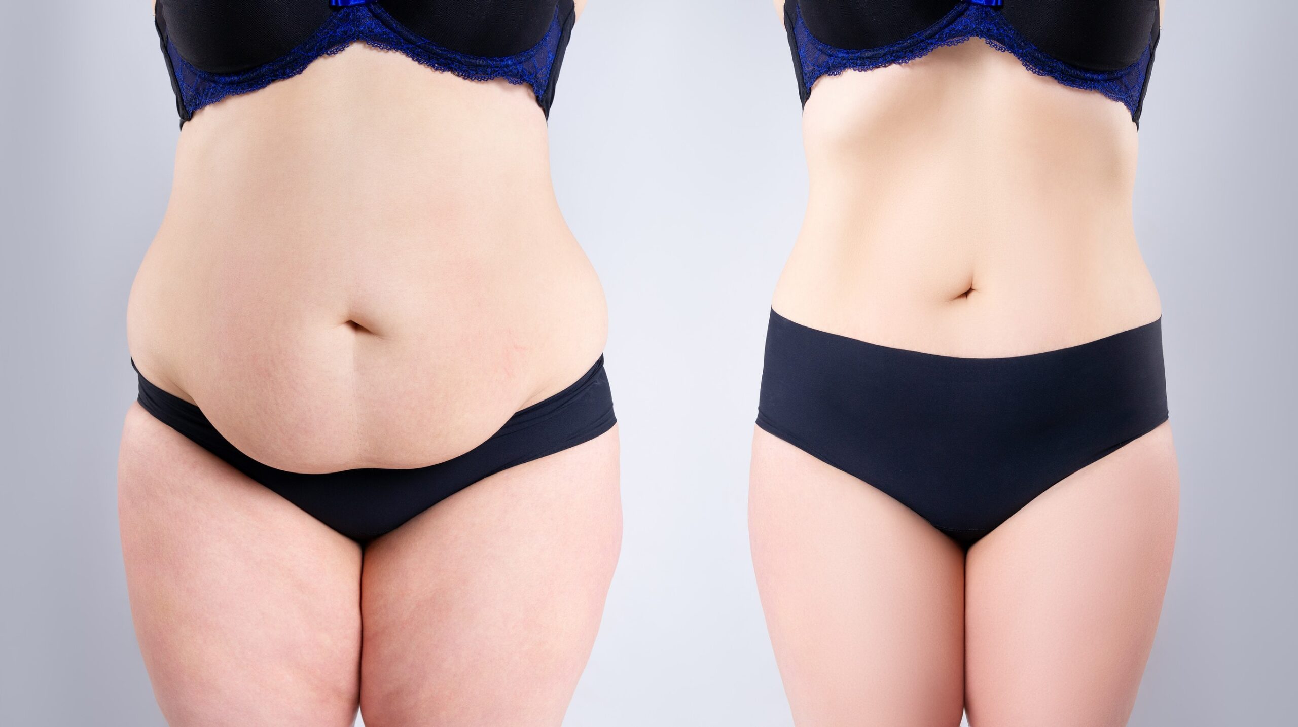 Risultati della liposuzione con laser, evidenziando miglioramenti estetici.