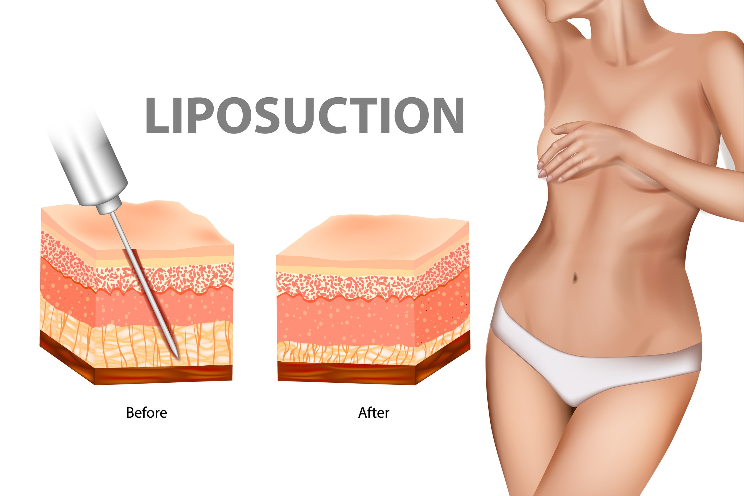 Schema che illustra il funzionamento dell'intervento di liposuzione ai fianchi.
