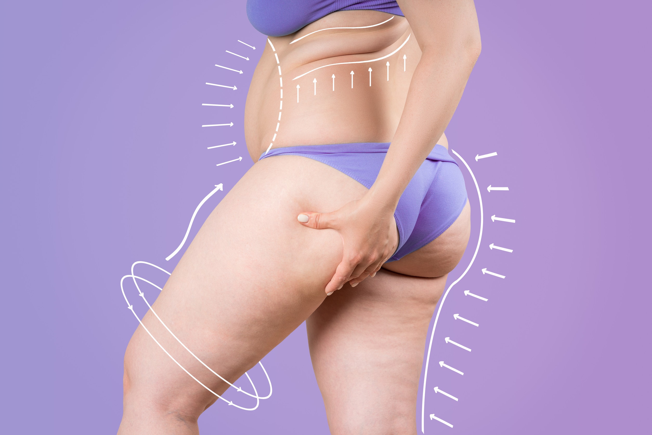Immagine che rappresenta una liposuzione andata male, con evidenti complicazioni estetiche.