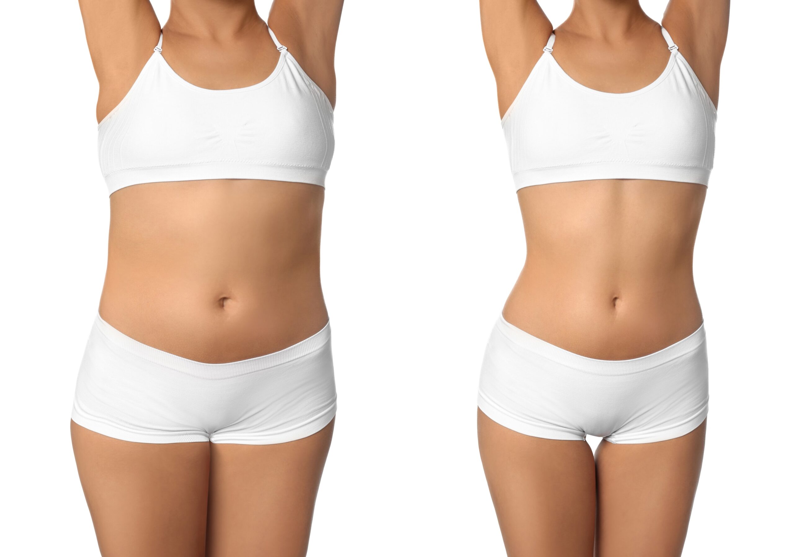 Foto prima e dopo la liposuzione, mostrando i risultati visibili dell'intervento.