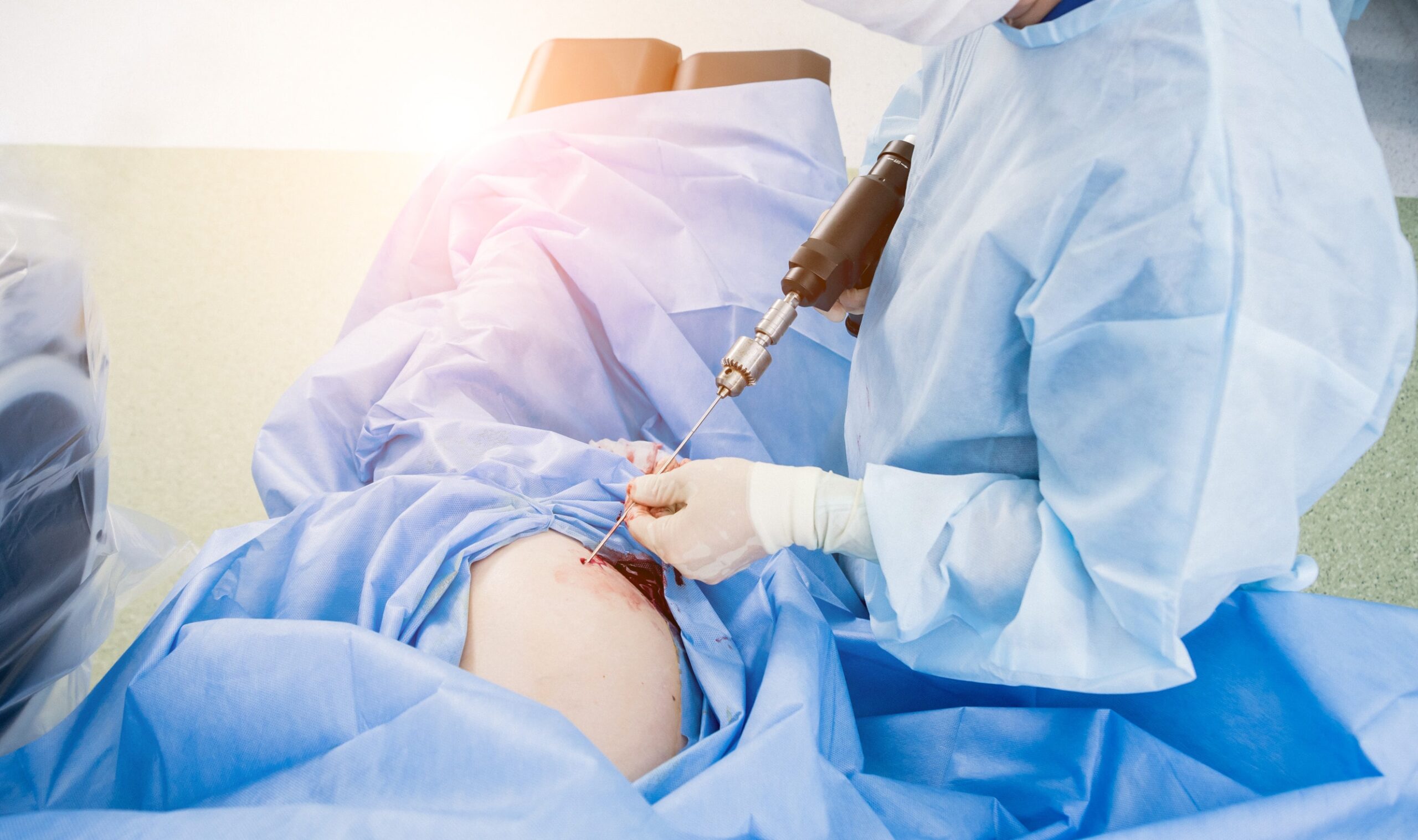 Occorre considerare la differenza tra liposuzione e altre procedure di perdita di peso.
