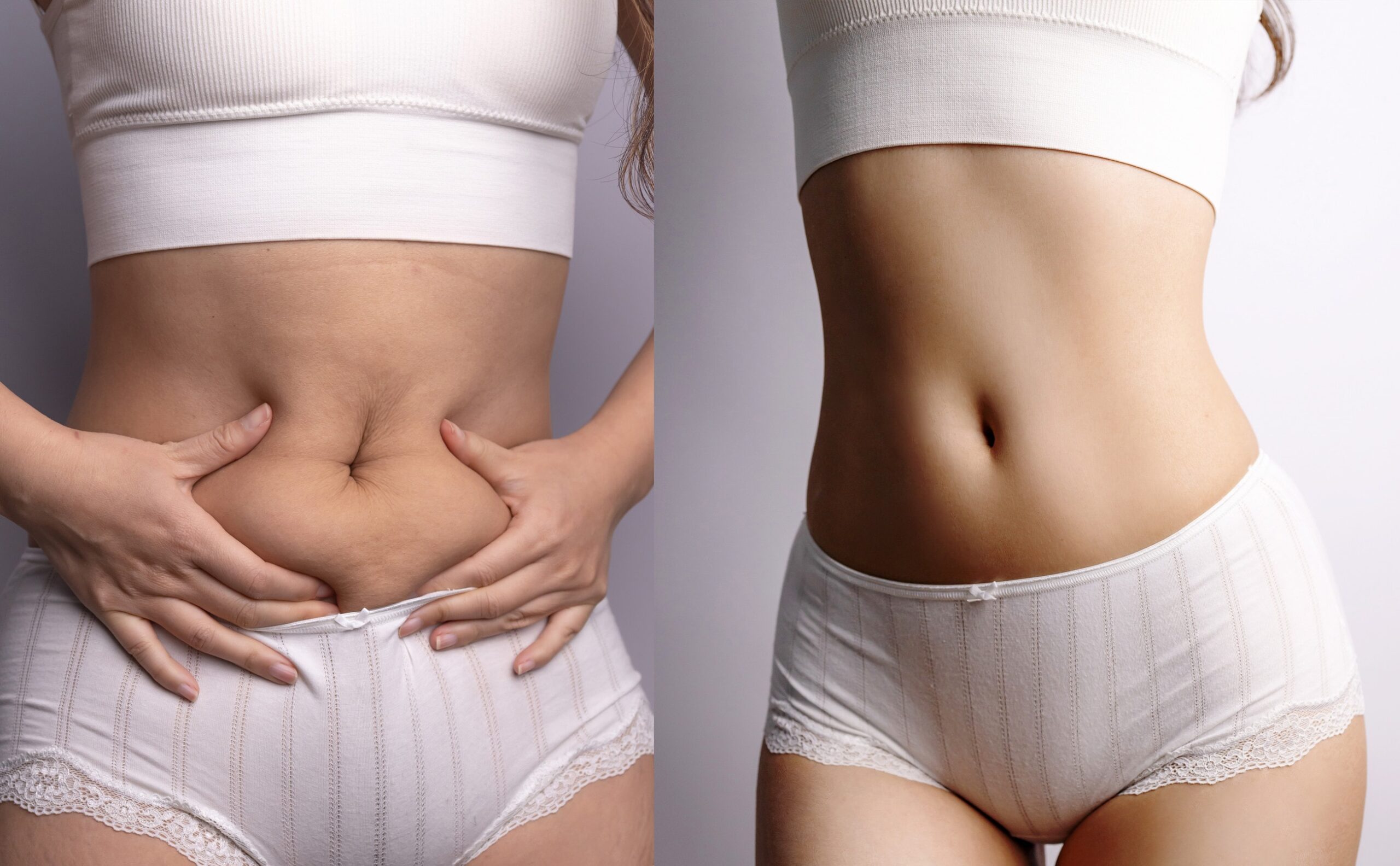 Un confronto visivo dei risultati della liposuzione addominale prima e dopo l'intervento.