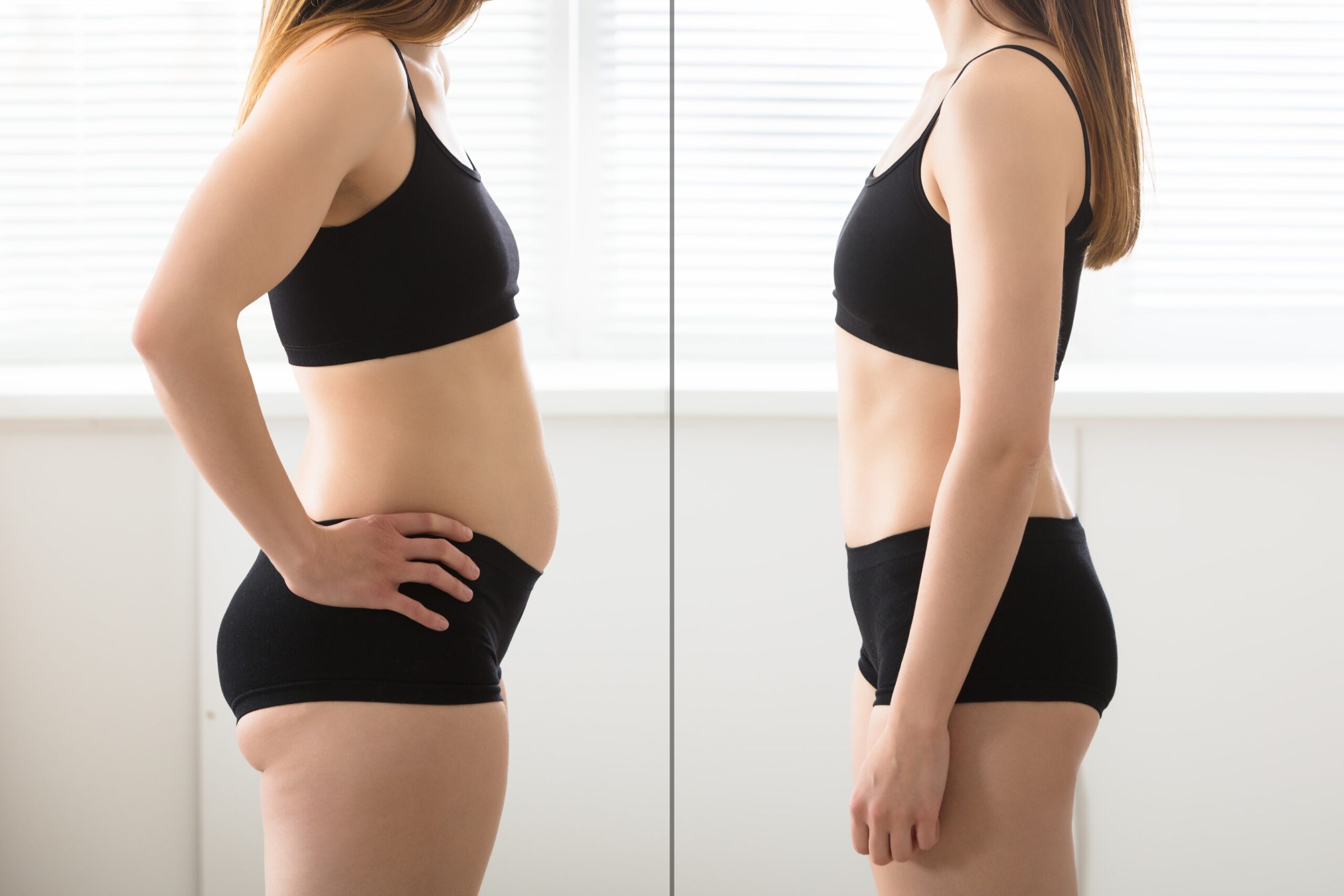 Foto prima e dopo l'intervento di liposuzione addominale