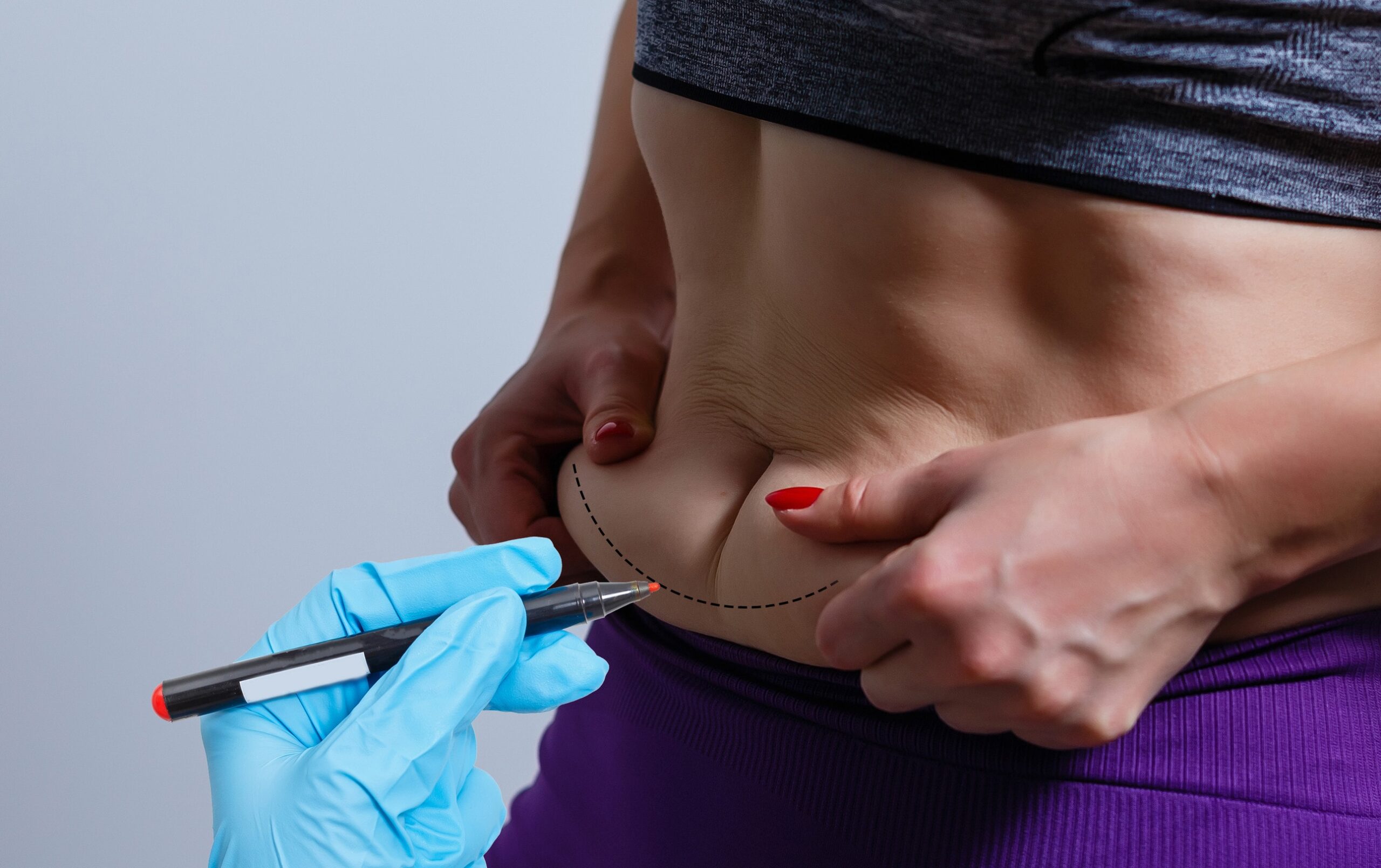 La liposuzione addominale si applica ad aree di tessuto adiposo.