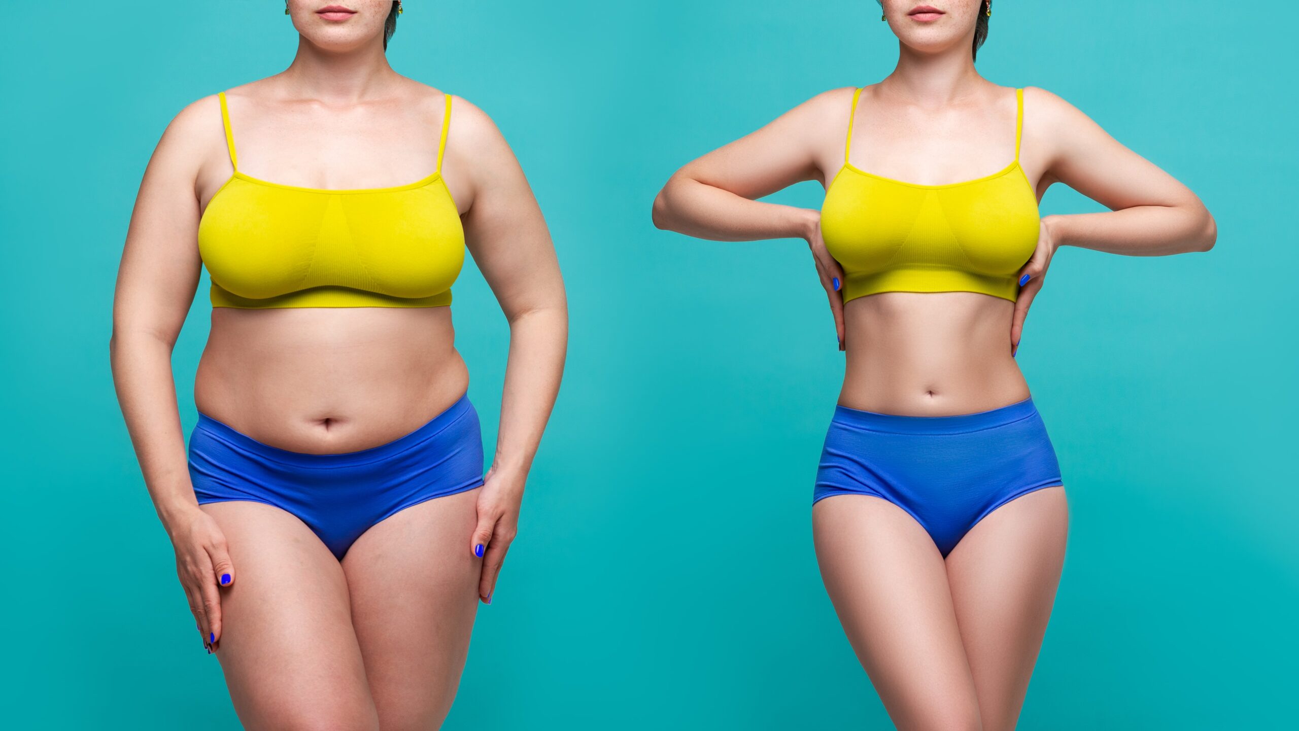 Liposuzione fianchi prima e dopo, evidenziando i cambiamenti nei risultati.