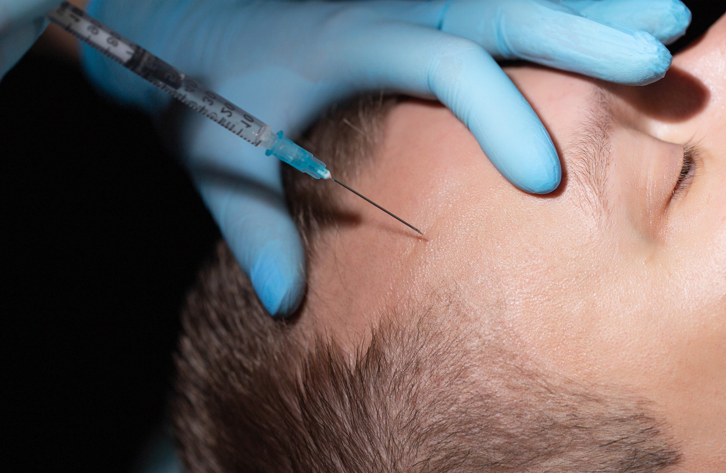 Trapianto capelli con cellule staminali: una soluzione innovativa per la ricrescita dei capelli.