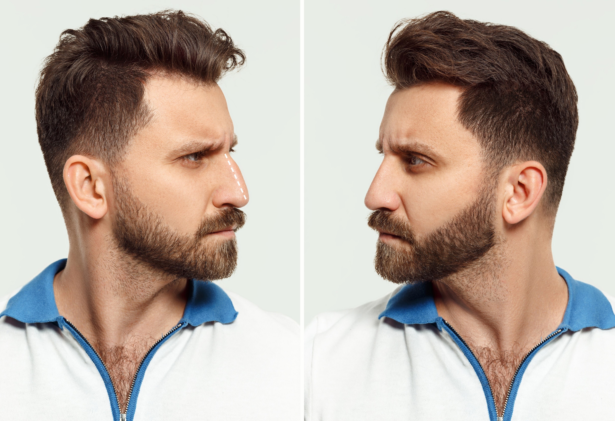 Esempi di risultati di rinoplastica uomo prima e dopo.
