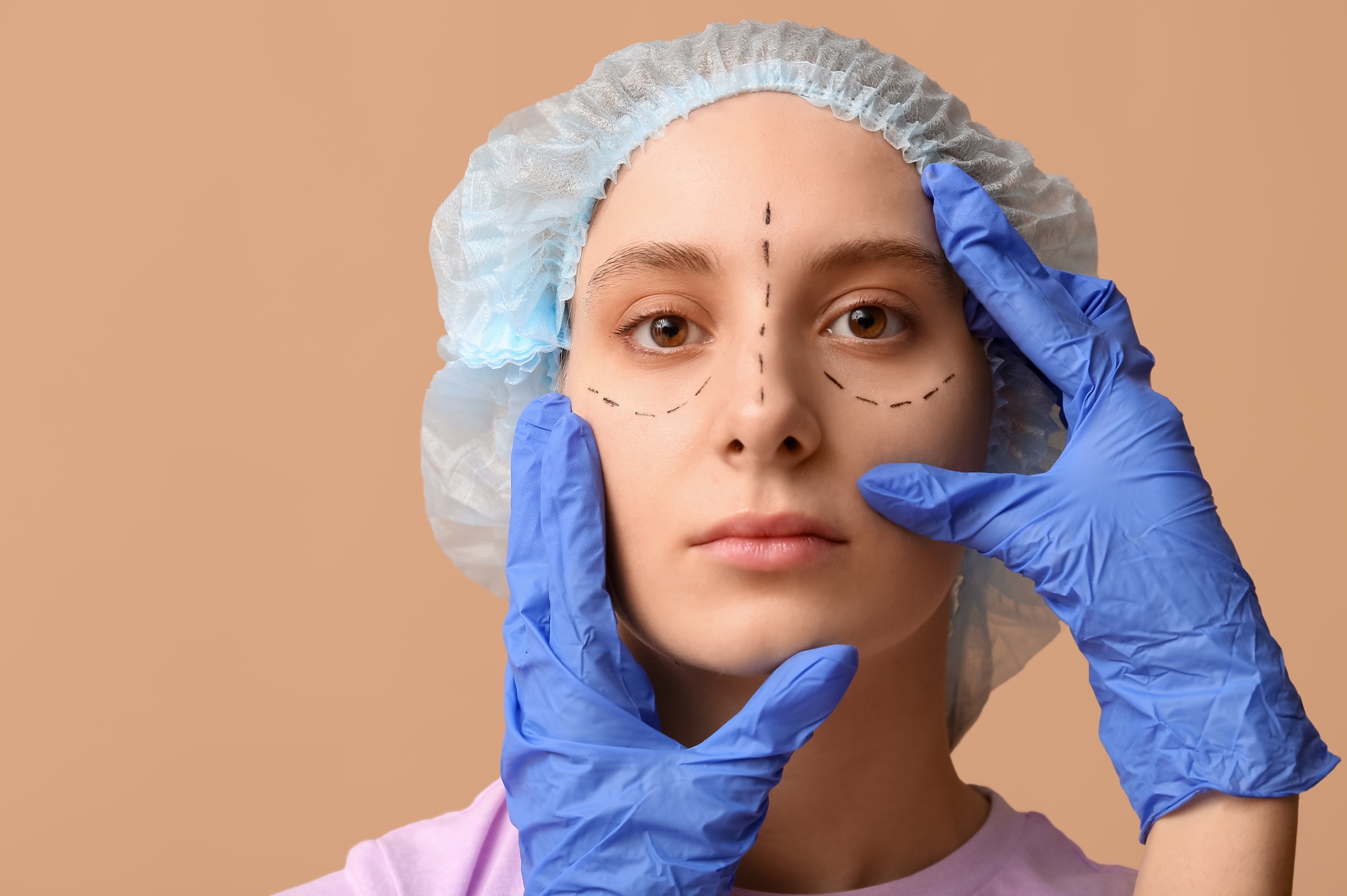 Cura post-operatoria dopo un mese dall'intervento di blefaroplastica.