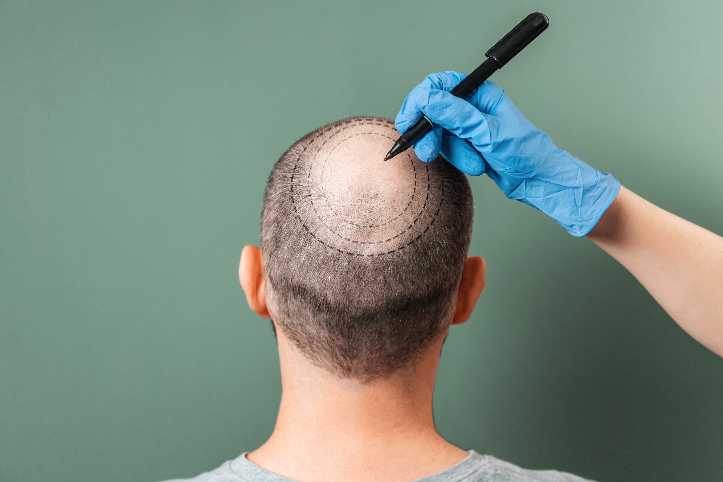 Un tricologo esamina il paziente sul quale effettuerà il trapianto di capelli.