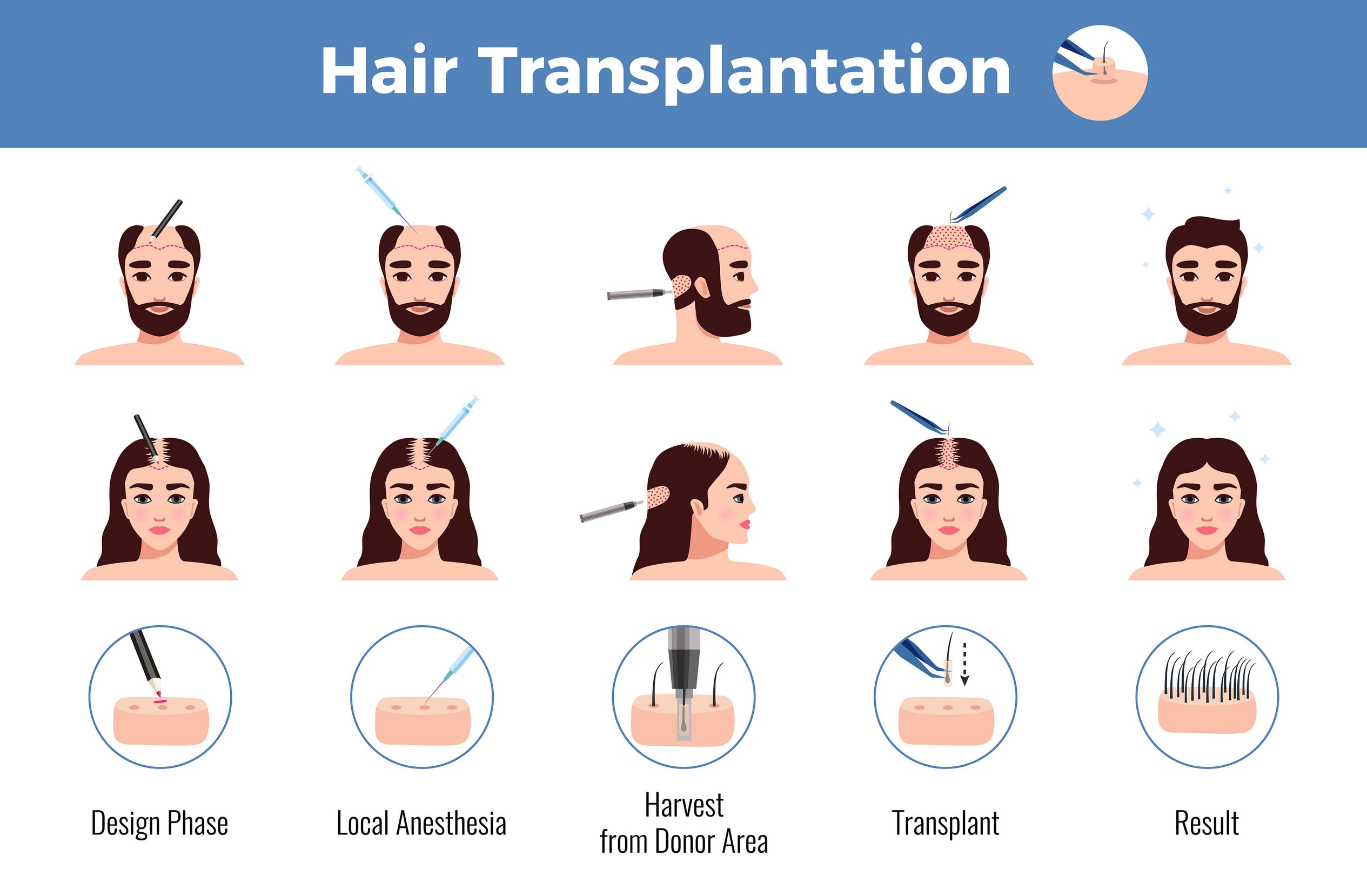 Un'immagine che illustra come funziona un trapianto di capelli.