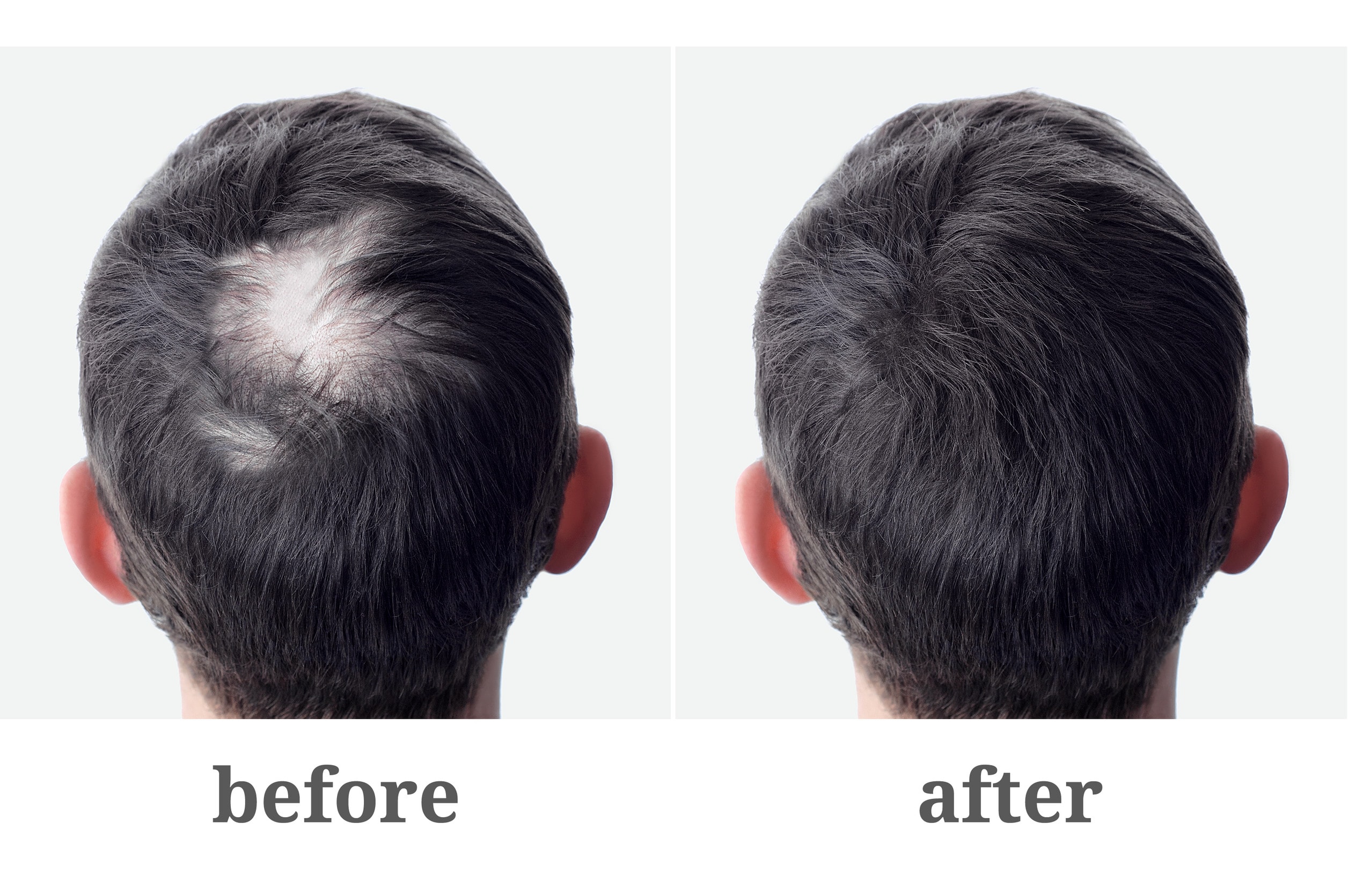 Risultati sorprendenti del trapianto di capelli prima e dopo.