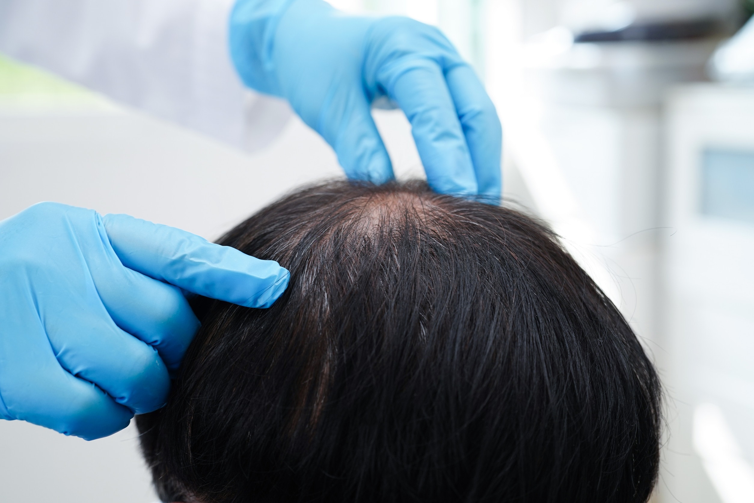 Monitoraggio della ricrescita dei capelli dopo un mese dal trapianto.