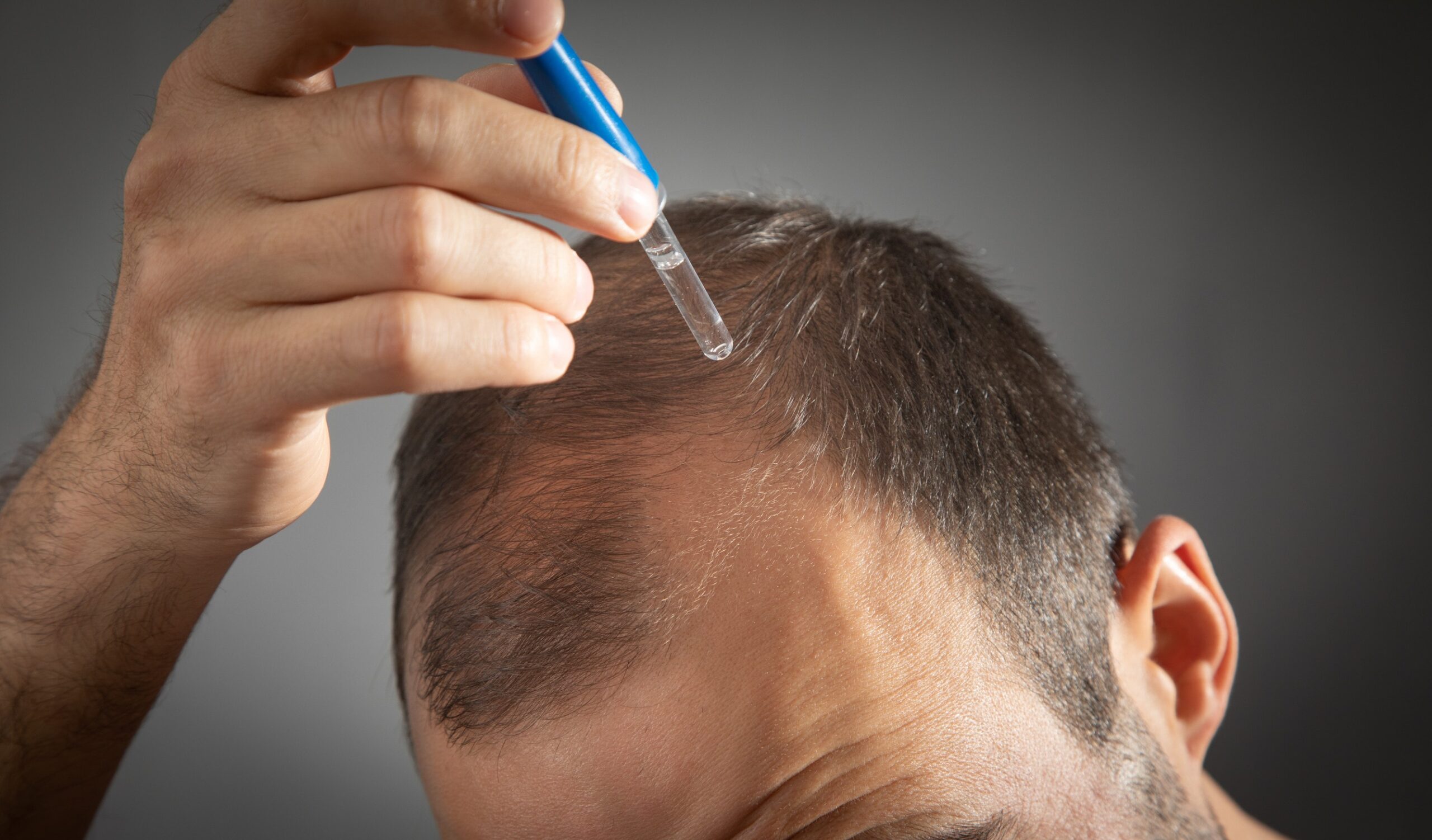 Cura post-operatoria un mese dopo il trapianto di capelli.