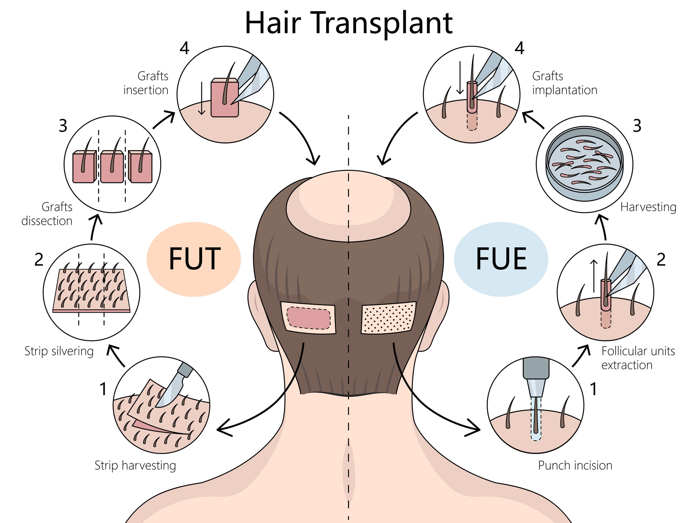 Tecniche di trapianto di capelli, tra cui FUT e FUE.