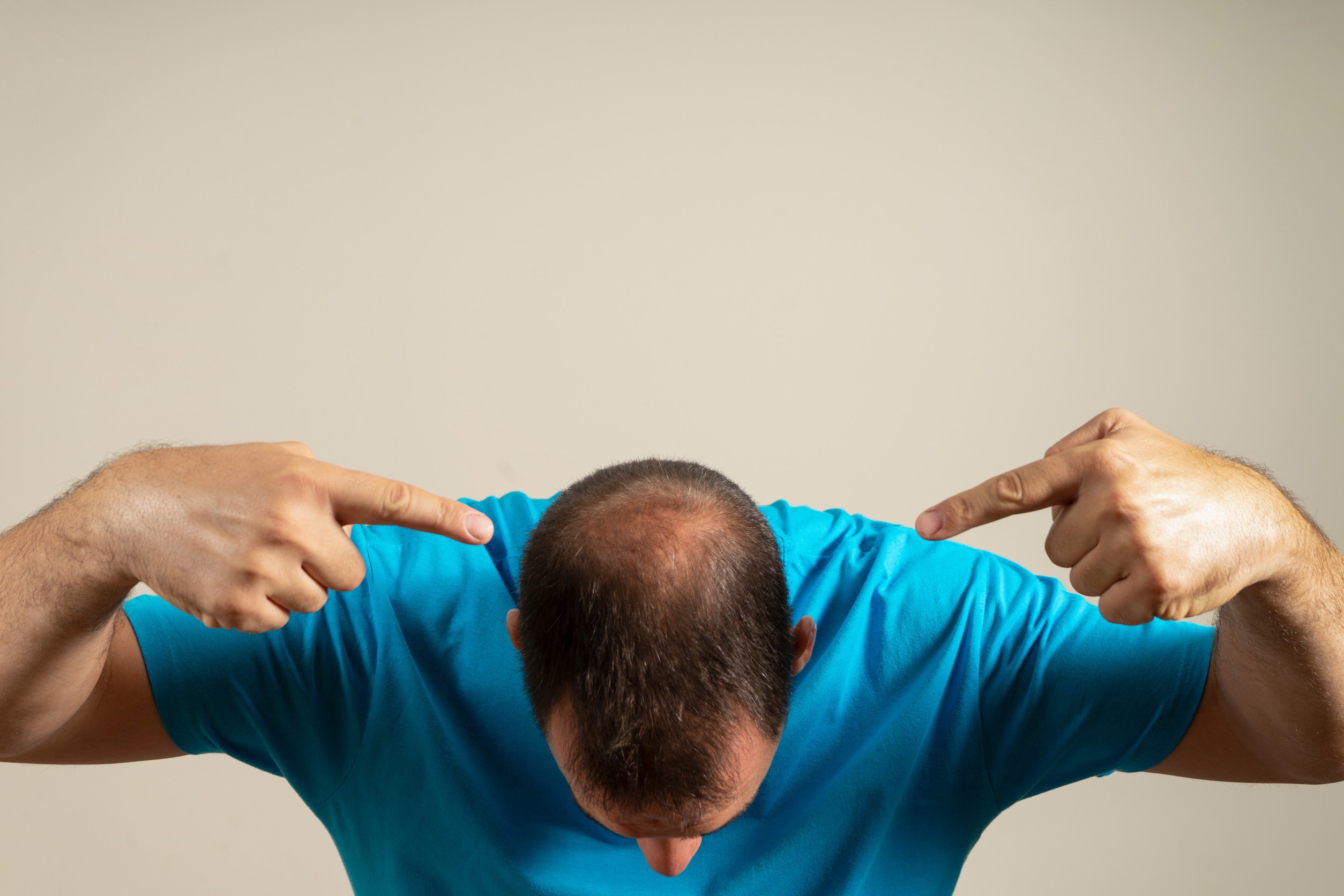 Una persona che sta valutando il trapianto di capelli.
