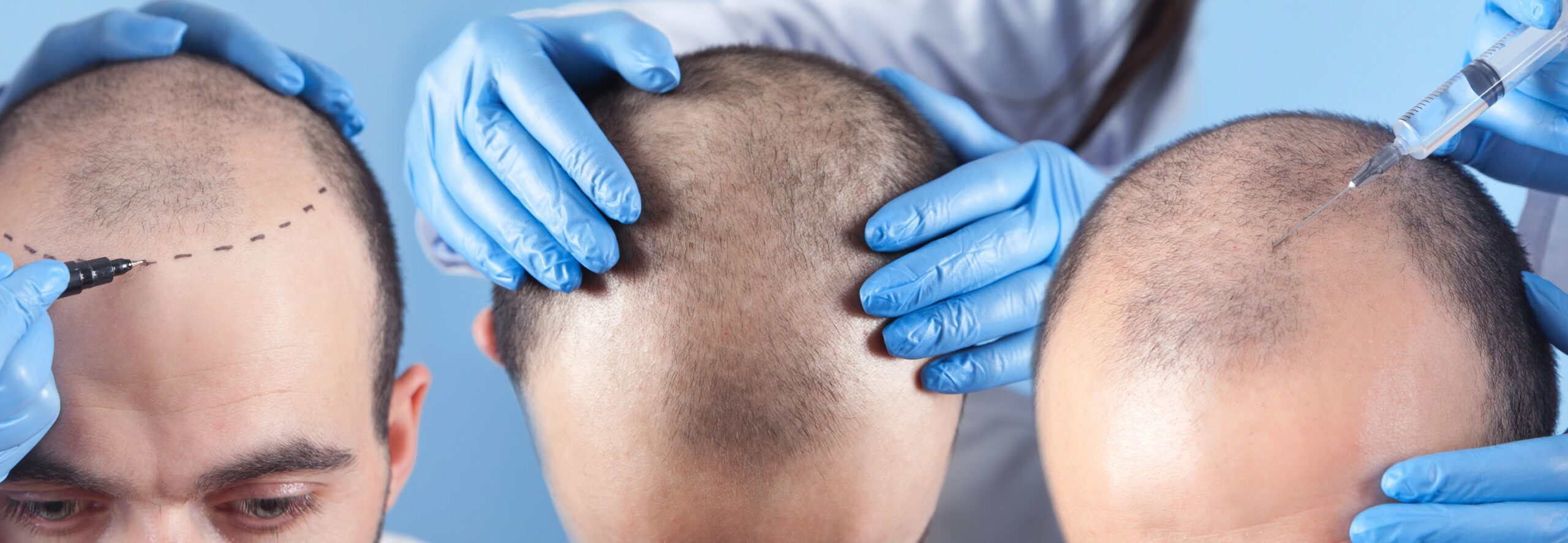 Trapianto capelli dopo 1 mese: i risultati iniziali.