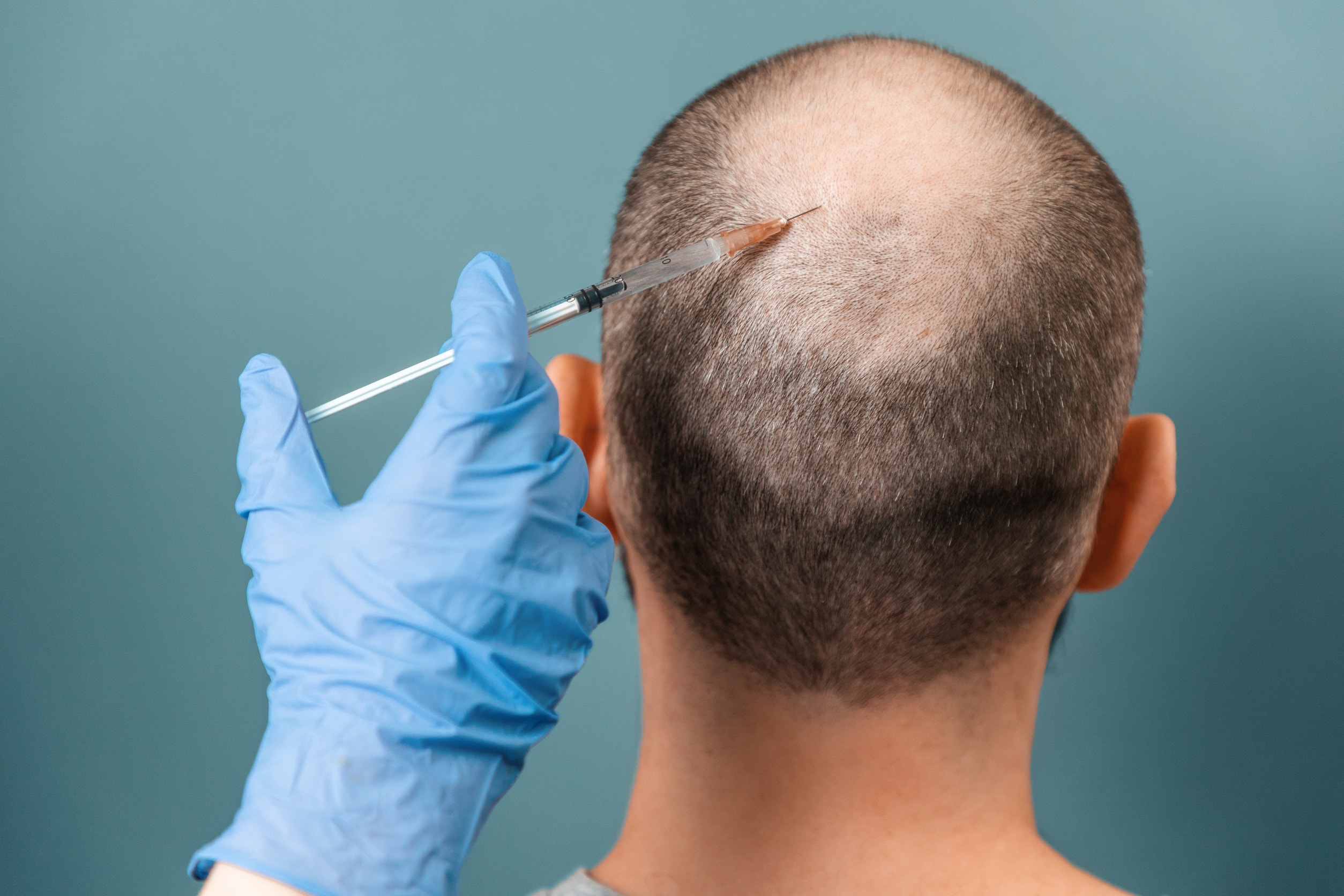 Chi può beneficiare del trapianto capelli con cellule staminali? Informazioni sui candidati ideali.