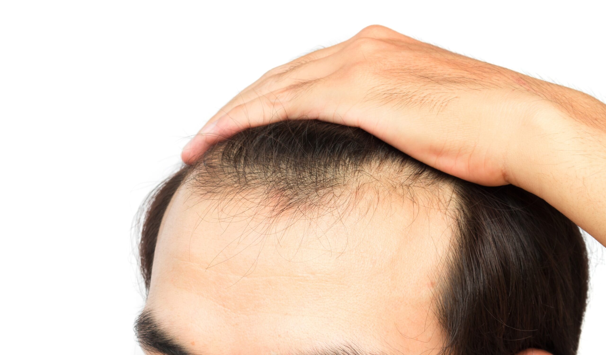 Risultati post-operatori di un trapianto di capelli FUE, con capelli che ricrescono.