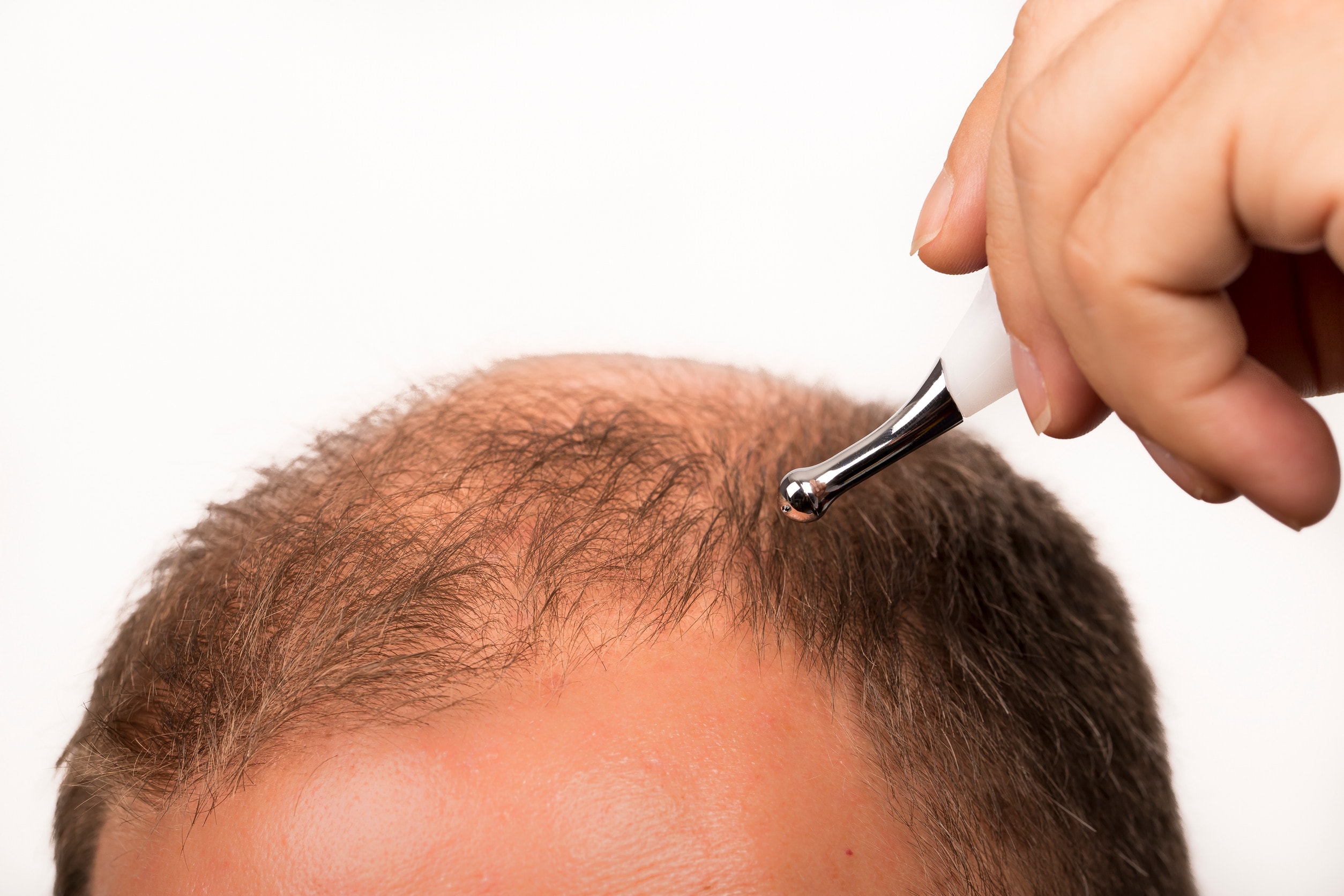Fasi preliminari di un intervento di trapianto di capelli DHI