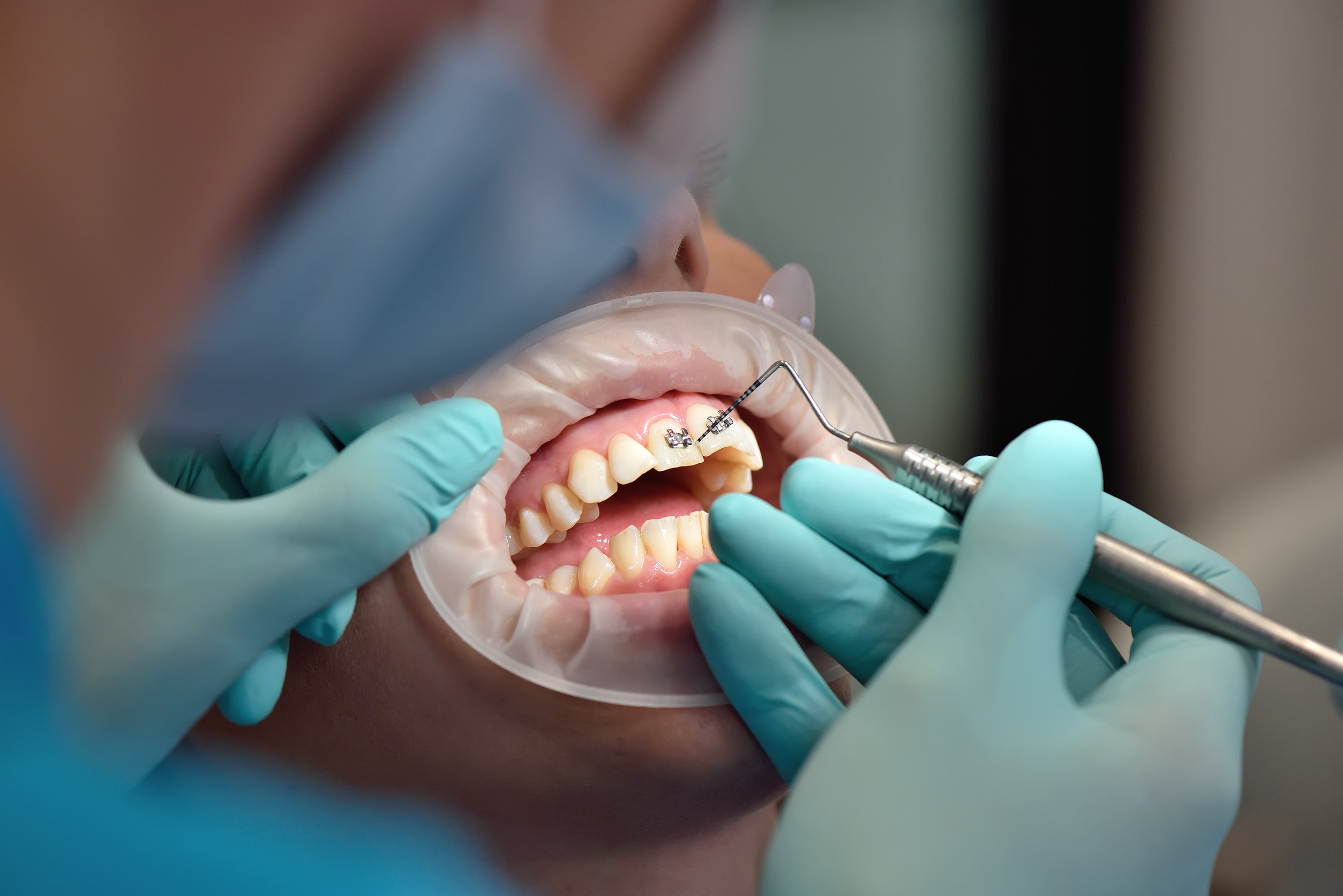 Immagine che rappresenta il processo di come si fa un impianto dentale.