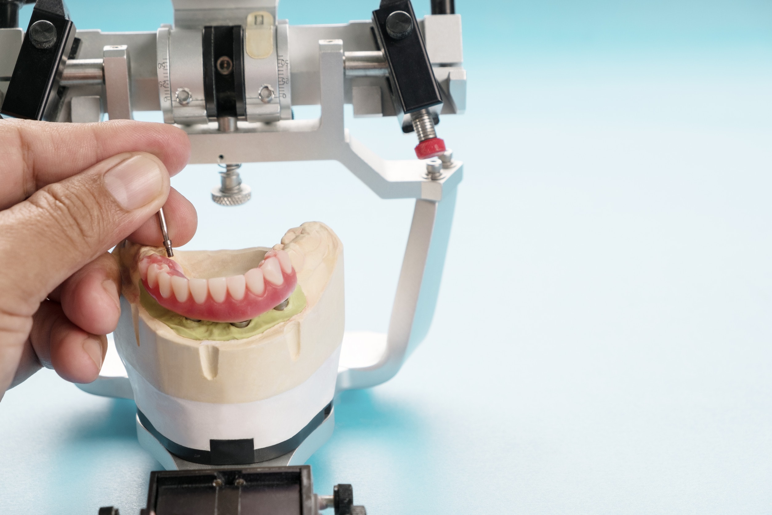 Mini impianti dentali e loro applicazioni.