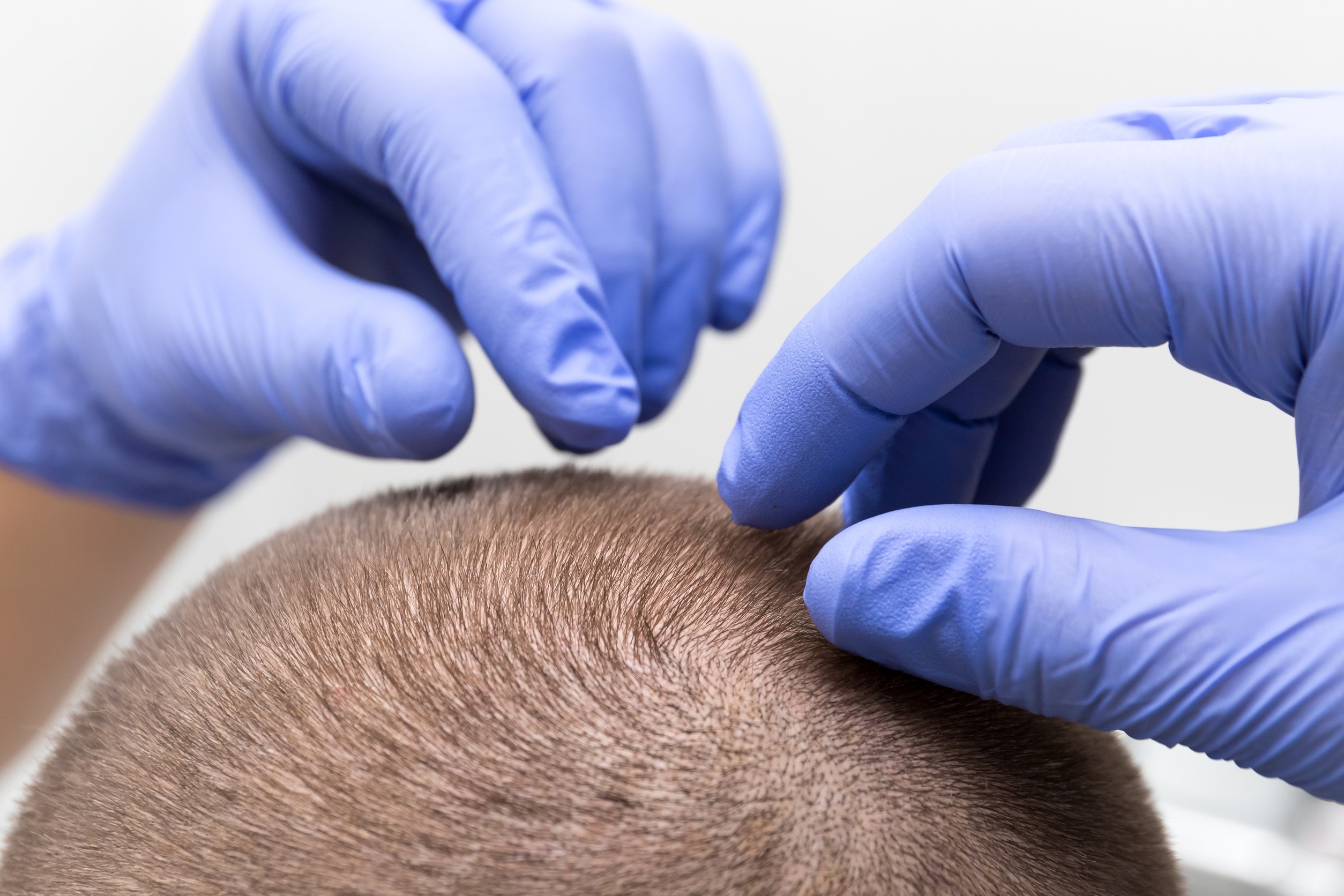 Procedura del trapianto capelli DHI in corso.
