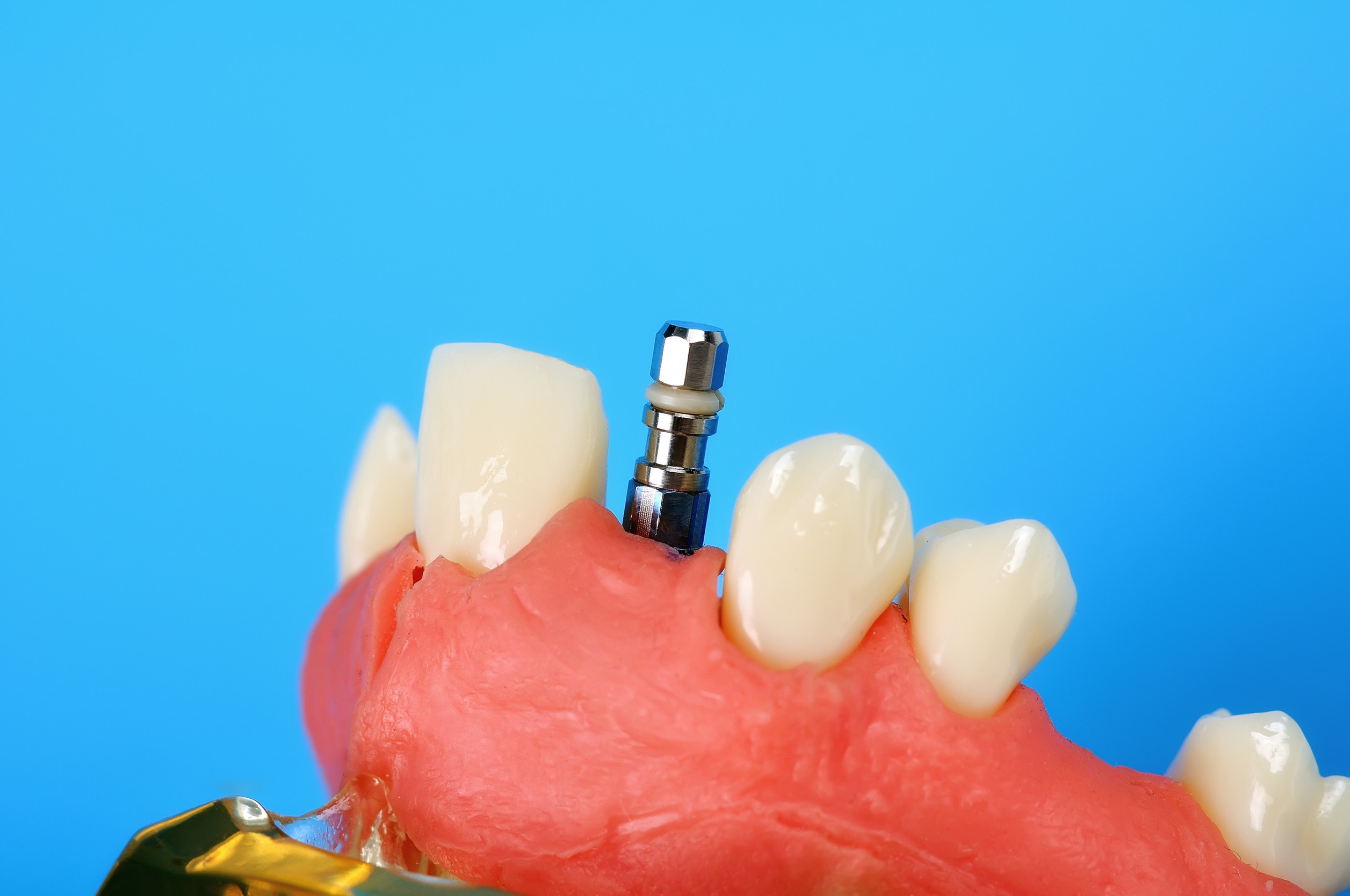 Impianto dentale singolo in primo piano, evidenziando la sua struttura e funzionalità.