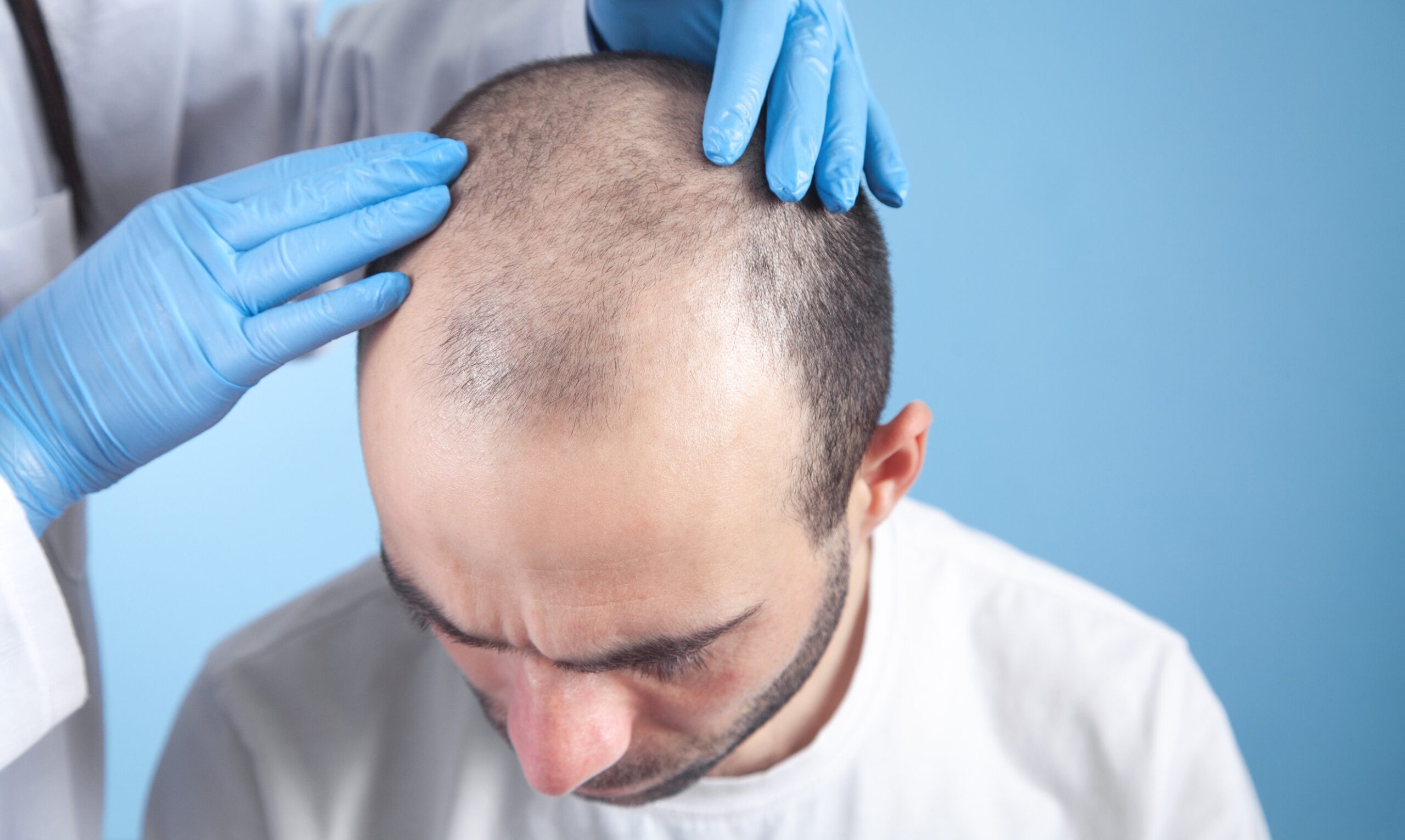 Un paziente viene esaminato un mese dopo il trapianto di capelli.