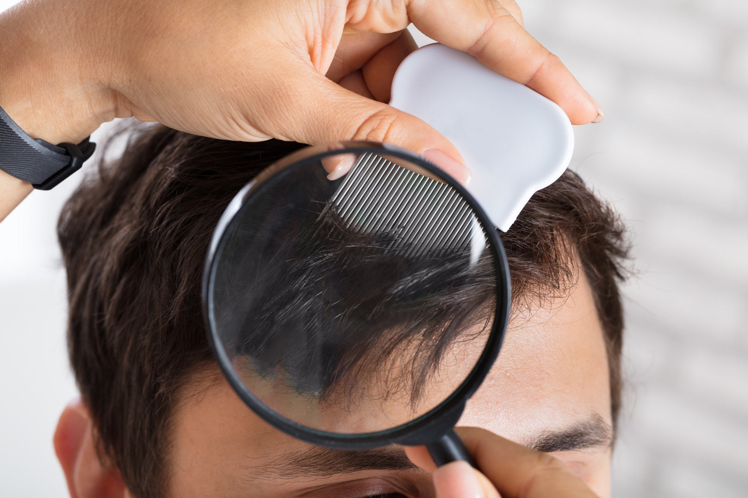La durata dei risultati del trapianto di capelli dipende da diversi fattori.