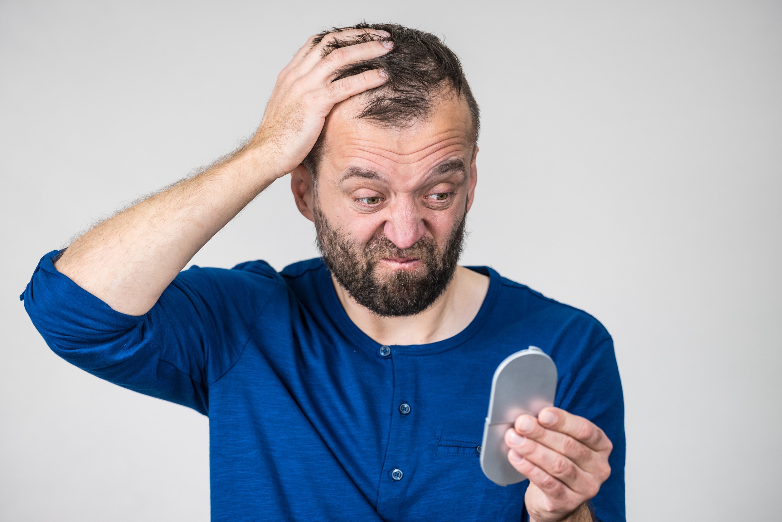 Un esempio di trapianto di capelli andato male
