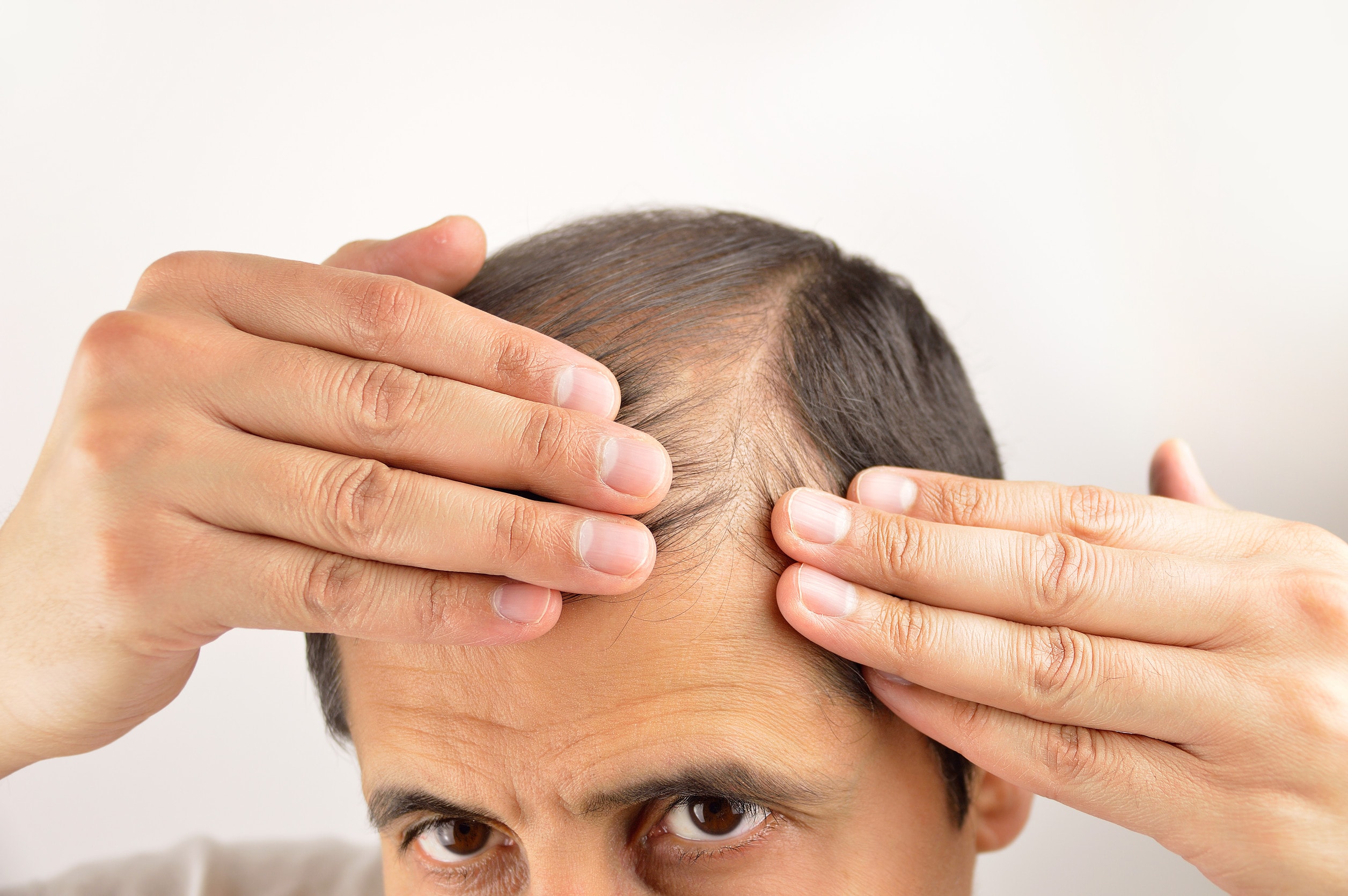 Cambiamenti visibili e ricrescita dei capelli dopo un mese.