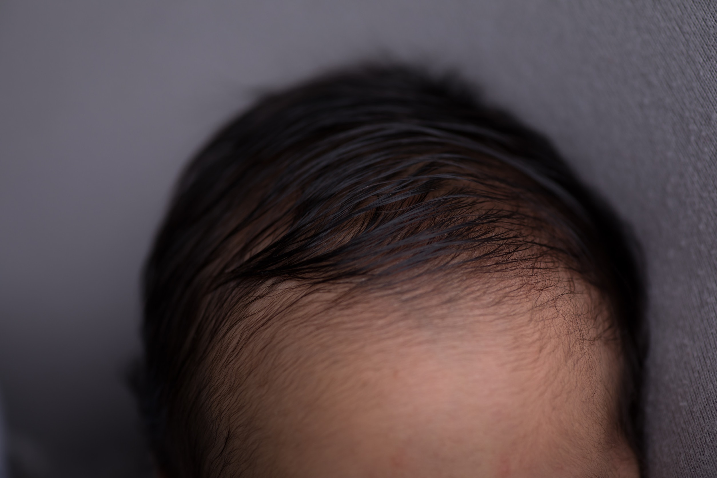 Risultati naturali e densi del trapianto capelli DHI.