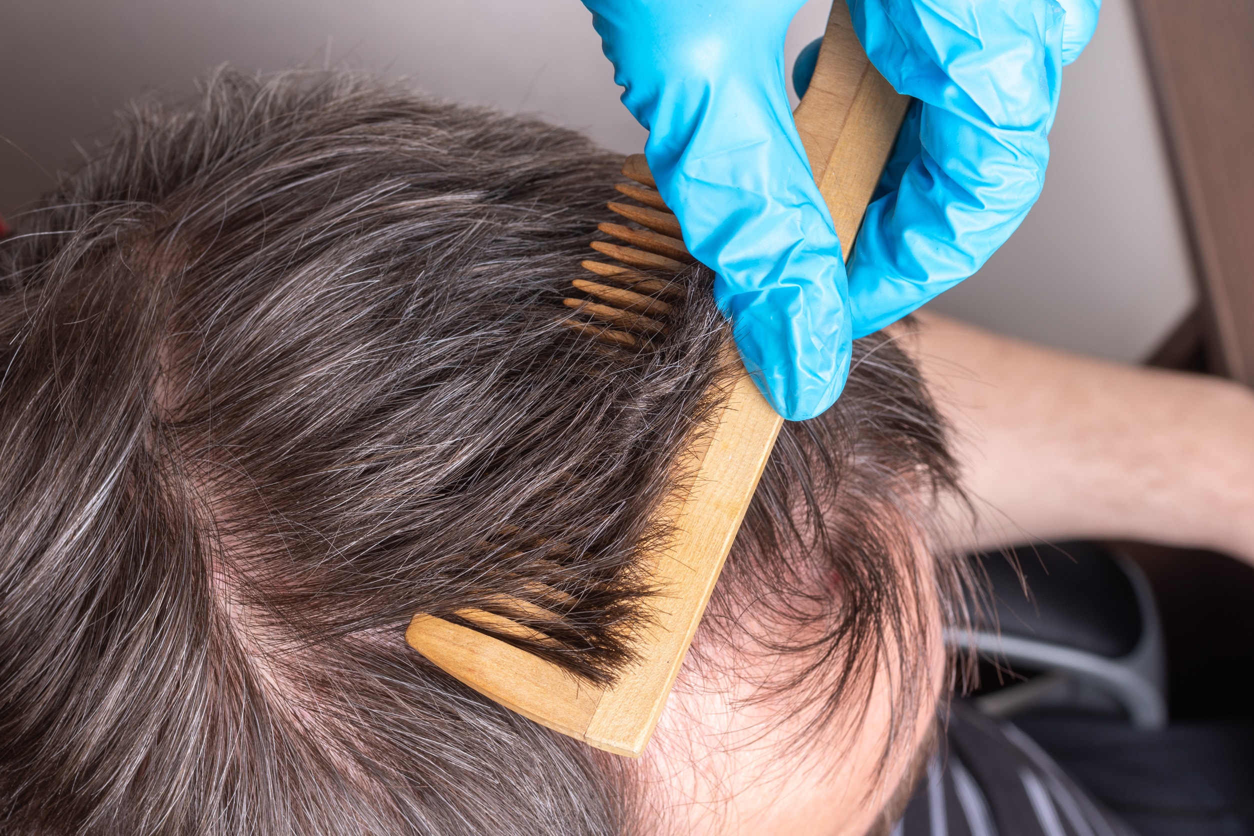 Benefici del trapianto capelli senza rasatura, mostrando risultati naturali e discreti.