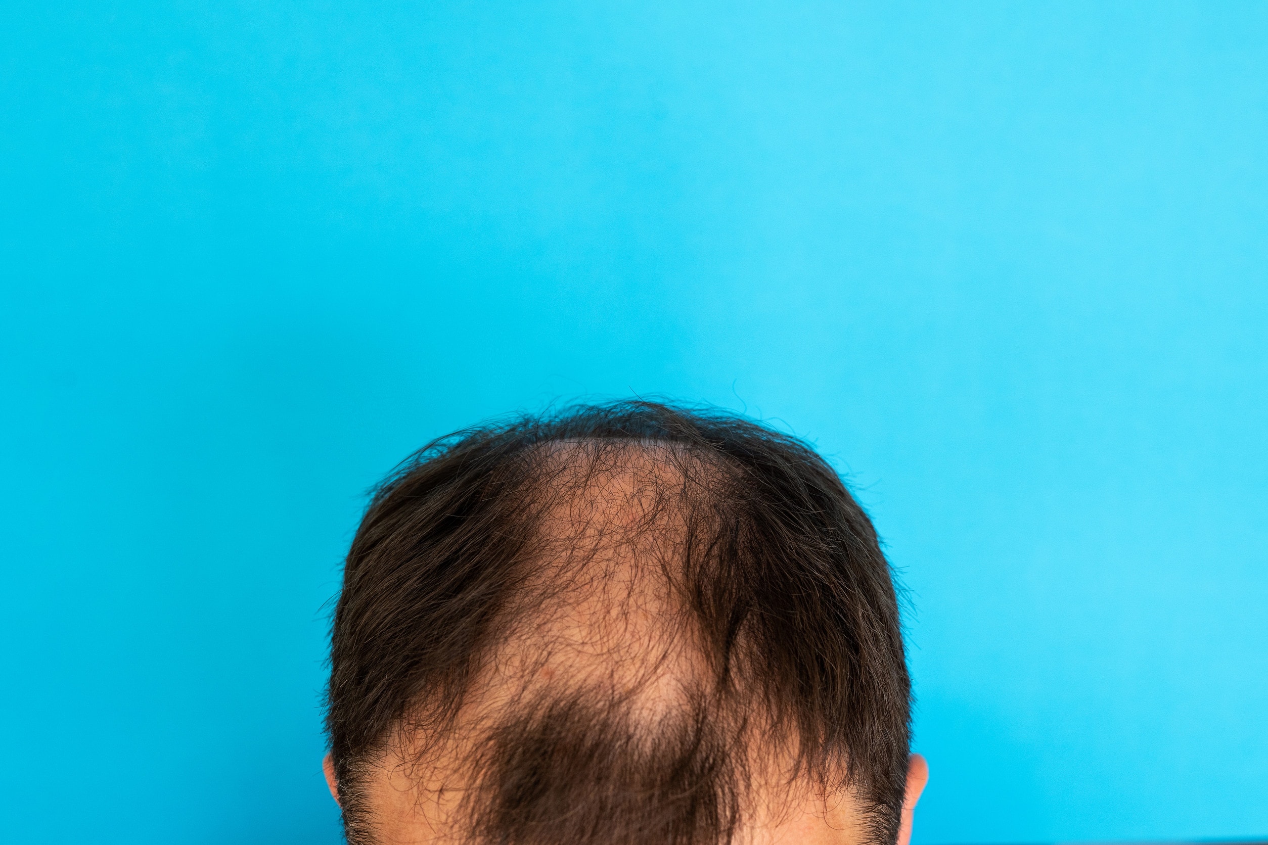 Segnali di un trapianto capelli non riuscito.