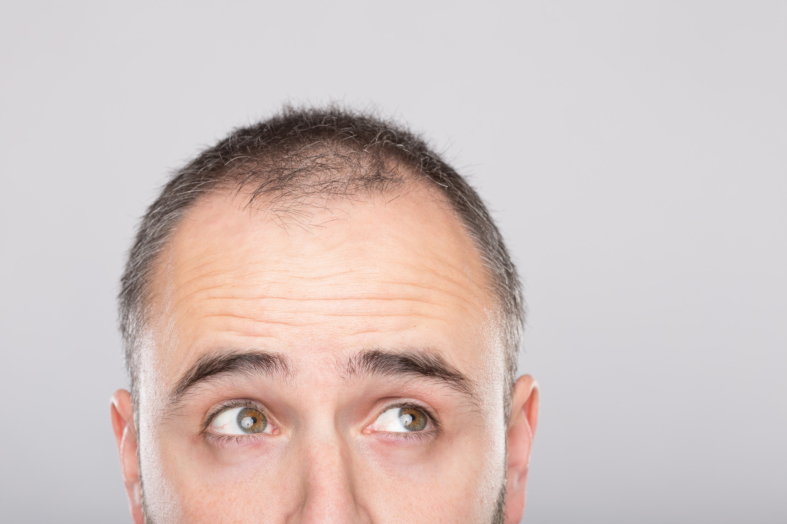 Primo giorno dopo il trapianto di capelli e le prime cure.