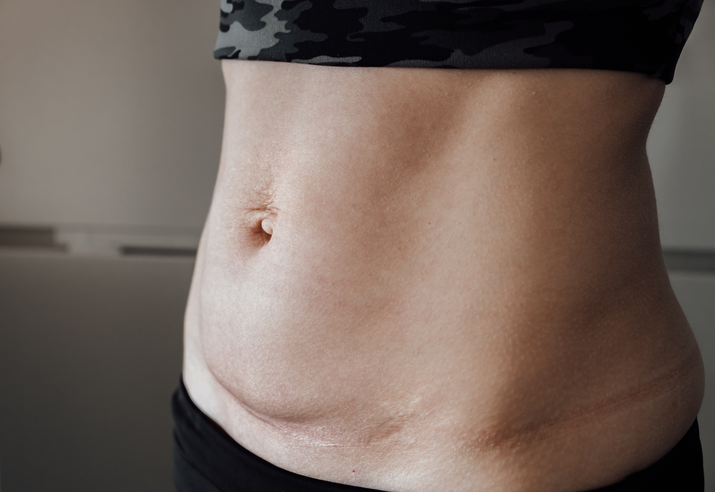 Le tecniche di autotrattamento per cicatrici addominoplastiche sono semplici da attuare ma richiedono costanza.