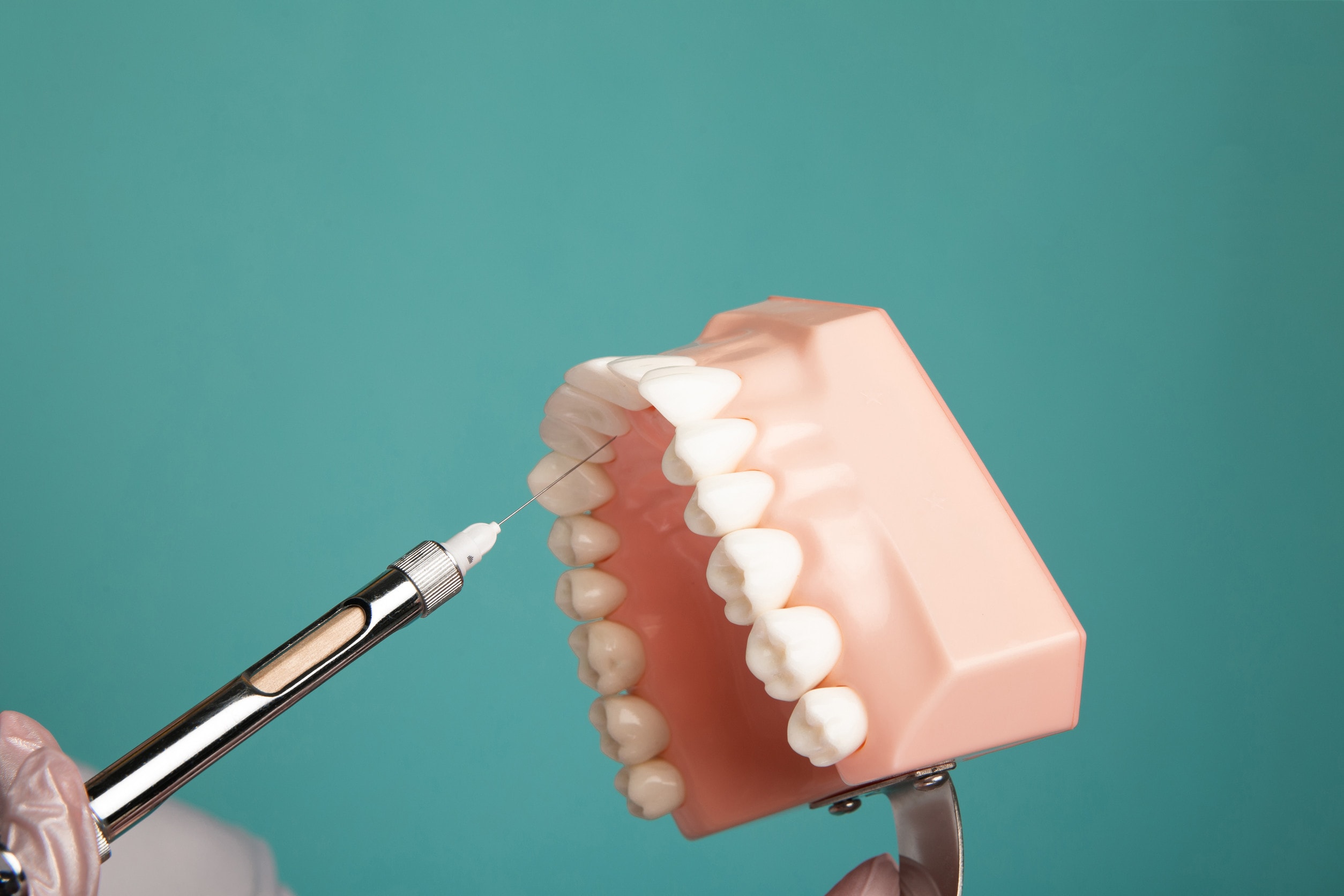 Impianti dentali senza viti, una nuova frontiera in odontoiatria.