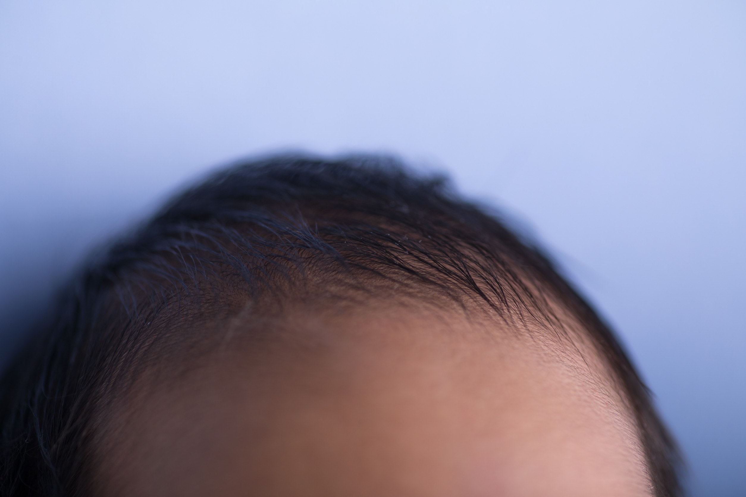 Aspettative sul trapianto di capelli dopo 3 mesi.